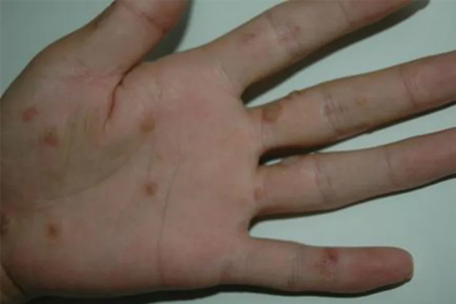 扁平疣是怎么导致的 导致扁平疣2大病因揭秘