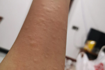 干性濕疹和濕性濕疹的區(qū)別