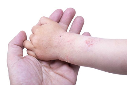 湿疹呈对称性分布是什么意思