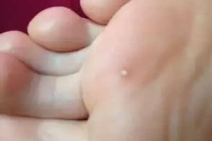 手上会长鸡眼吗 揭秘手上鸡眼的原因