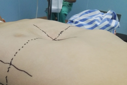 漏斗胸有什么危害 漏斗胸的这几个危害须知