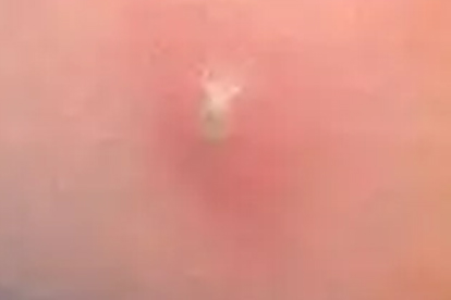 被臭虫咬过的皮肤会有哪些症状