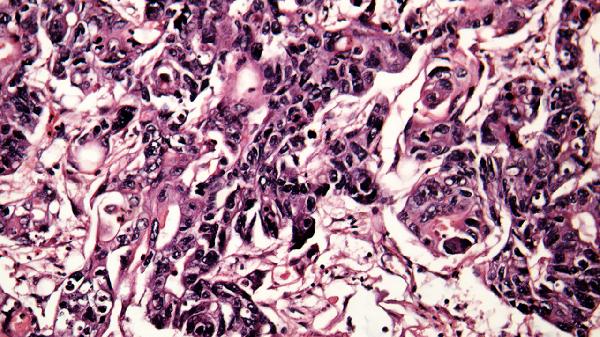 黄绿色浓痰是什么细菌感染