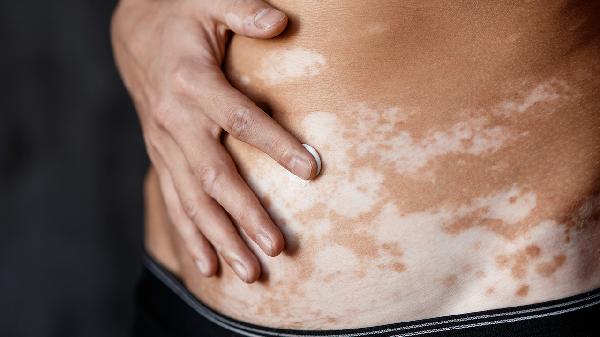 白癜风涂抹糠酸莫米松乳膏有用吗