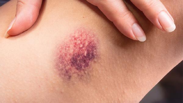 女性身上经常出现淤青的原因有哪些