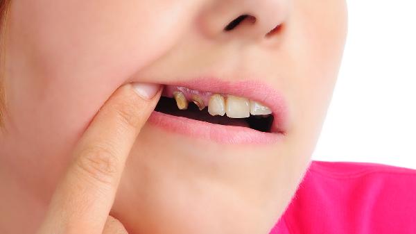 儿童牙髓炎可以自行恢复吗 多个疗法促进儿童牙髓炎康复