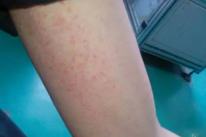 怎么治疗单纯性毛囊炎好得快