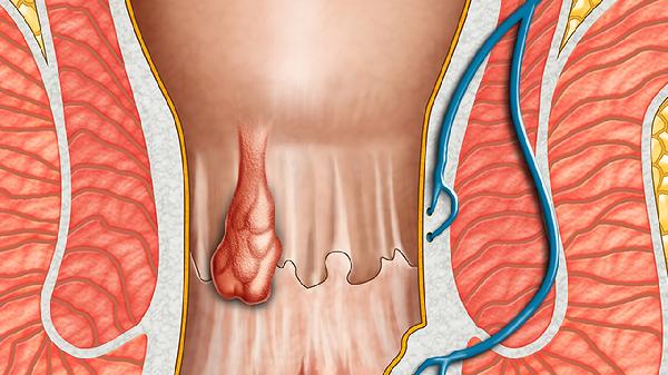 高脂血症对男性生殖系统有影响吗？