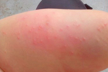 麻疹会传染吗 麻疹的两大传播途径要知