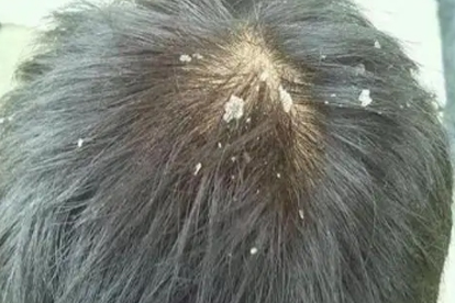 婴儿头发里有像头皮屑一样的东西