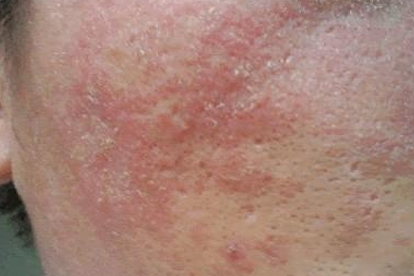 脂溢性皮炎的治疗方法盘点 3治疗方法远离脂溢性皮炎