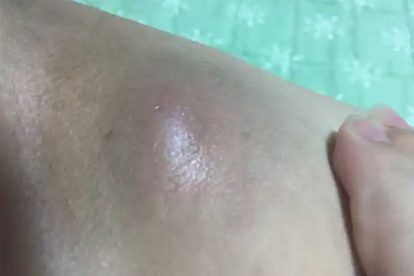 皮脂腺囊肿切除后该注意什么