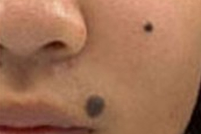 激光点痣后会留疤吗 如何避免激光点痣留疤