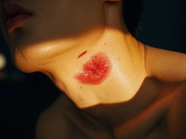 脖子上的草莓印怎样可以快速消除