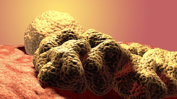 胸苷激酶与肿瘤五项是什么