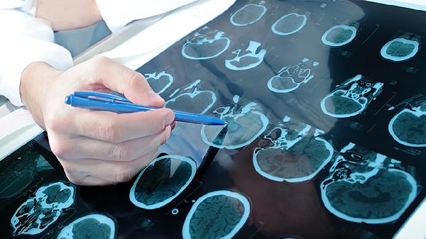 开颅手术颅骨会愈合吗 正确处理促进颅骨愈合