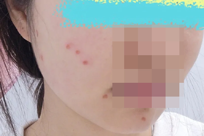 头皮痒还有结痂头屑怎么办