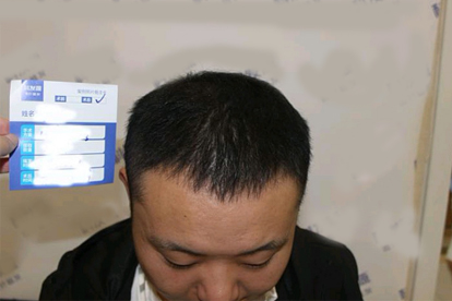 植发会掉吗 注意五方面避免植发掉发
