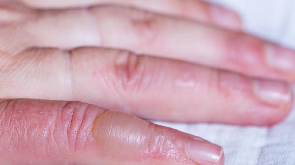 水疱型手癣什么原因造成的 水疱型手癣的3个原因要警惕