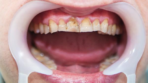 牙龈缝隙出脓液怎么回事，怎么办