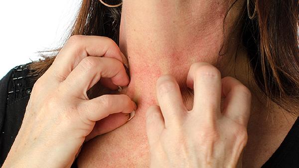 献血后皮肤很容易过敏怎么回事，怎么办