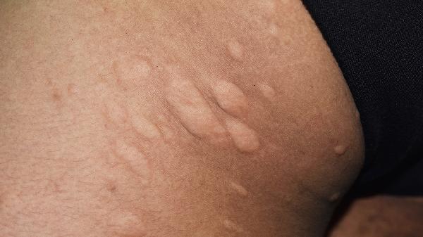 献血后皮肤很容易过敏怎么回事，怎么办