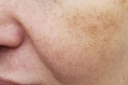男性长黄褐斑的治疗方法常见有哪些