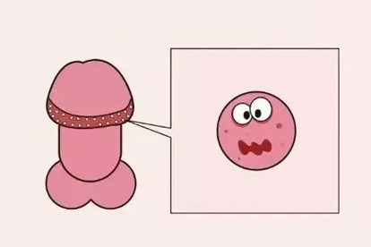 淋巴肉芽肿与珍珠疹的区别有哪些