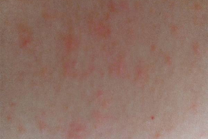 容易过敏是哪个脏腑出了问题