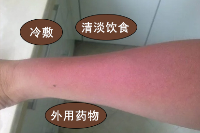 海边晒伤刺痛睡不着觉怎么回事，怎么办