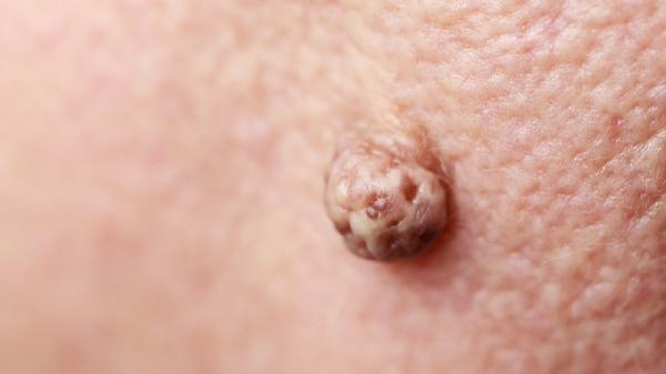 纤维瘤微创后注意事项有哪些