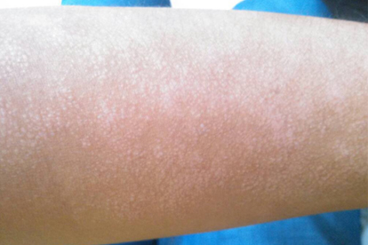 脚趾湿疹和真菌感染区别有哪些