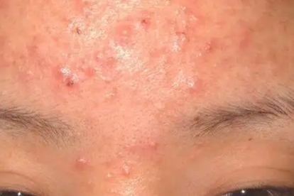痘痘上有白色的尖头可以挤掉吗