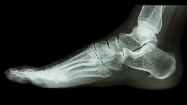 足跟骨折后遗症是什么 足跟骨折的3个后遗症揭晓