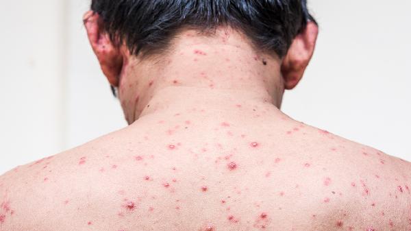成人长水痘需要注意什么 成人长水痘需注意四点