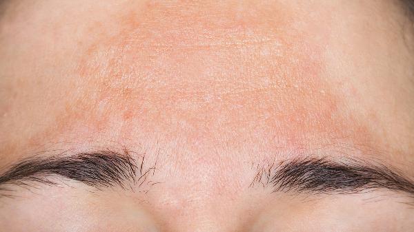 酒后皮肤出现红斑是过敏吗 了解酒精过敏带来的症状表现