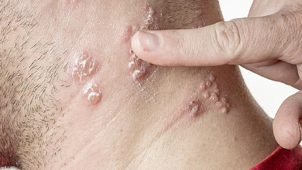 大疱性表皮松解症有哪几种