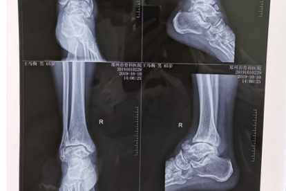 双脚是健康的“放大镜”！若是出现这几种迹象，或许是疾病的信号