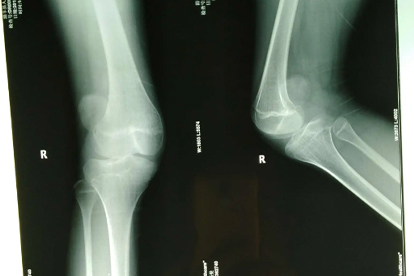 复发性髌骨脱位应该做哪些检查