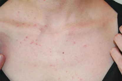 接触性皮炎会留下印子吗 6招消灭接触性皮炎疤痕