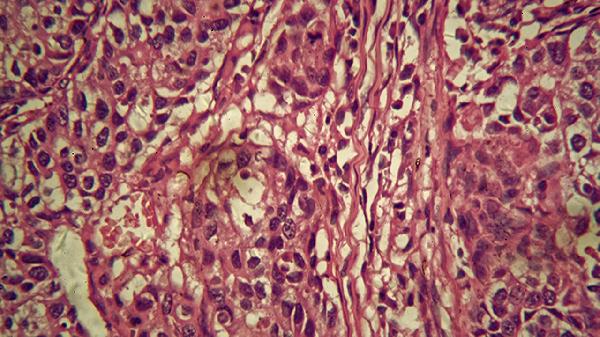 小儿噬血细胞综合征有什么临床表现