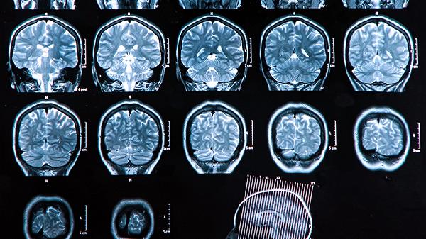腦血栓的治療方法有哪些  3個(gè)方法及時(shí)溶解腦血栓