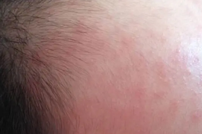 感染腺病毒后身上好多红疹子