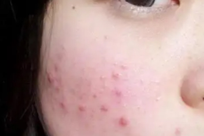 毛囊炎后期形成硬疙瘩怎么回事