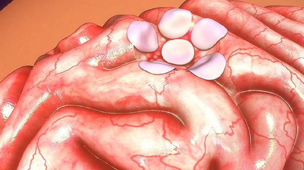 磨玻璃结节有血管穿过是什么意思