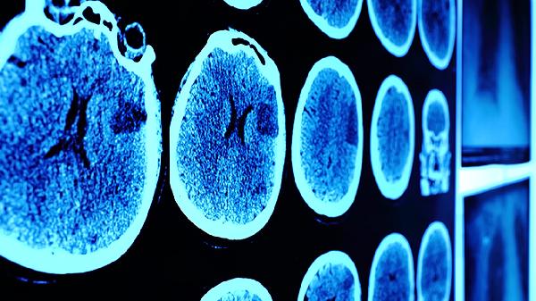 脑震荡的病因有哪些 脑震荡的5个病因分析
