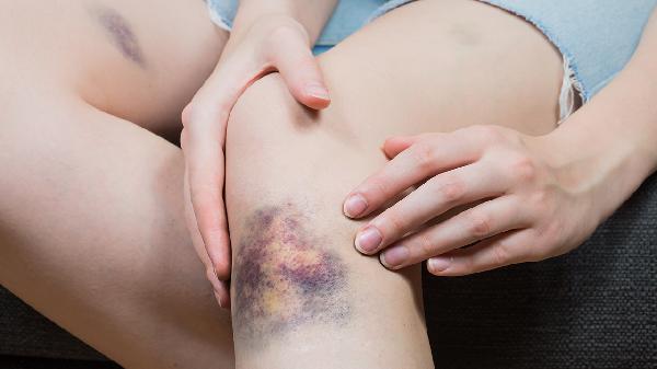 撞青了热敷还是冷敷 三个方法快速消除淤青