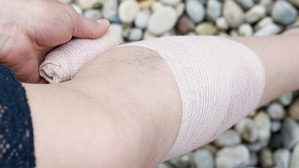 新鲜侧副韧带损伤如何治疗