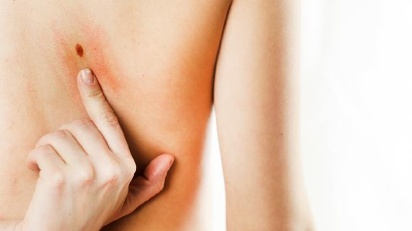 骨化纤维瘤复发率高吗 骨化纤维瘤复发的几个原因细说