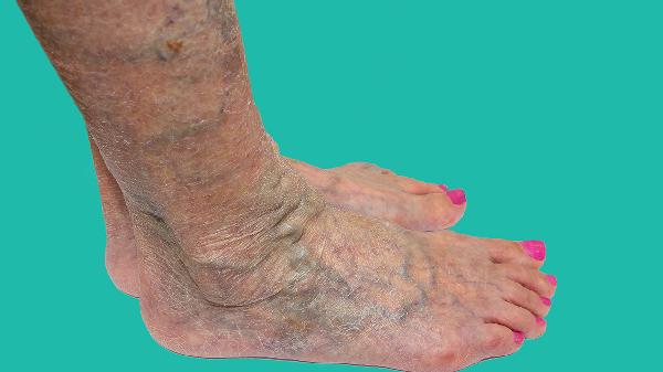 一级的脉管炎的预防方法有哪些